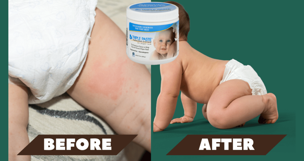 before and After diaper rash cream 